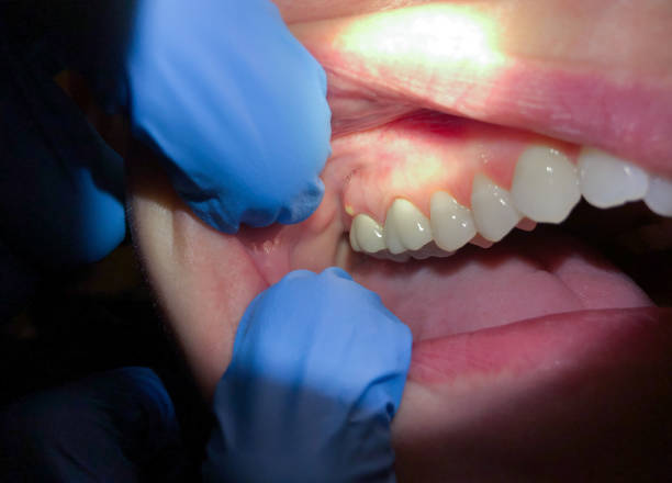 Best Tooth Infection Emergency Dentist  in Porterville, CA